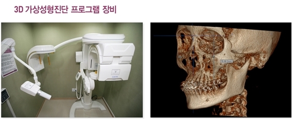 양악수술 전후 얼굴이 달라졌어요 2