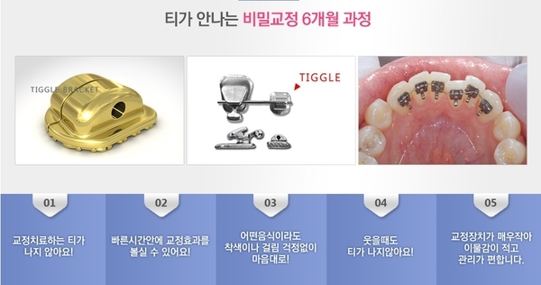 돌출입교정 기간 비용 궁금하시다면? 2